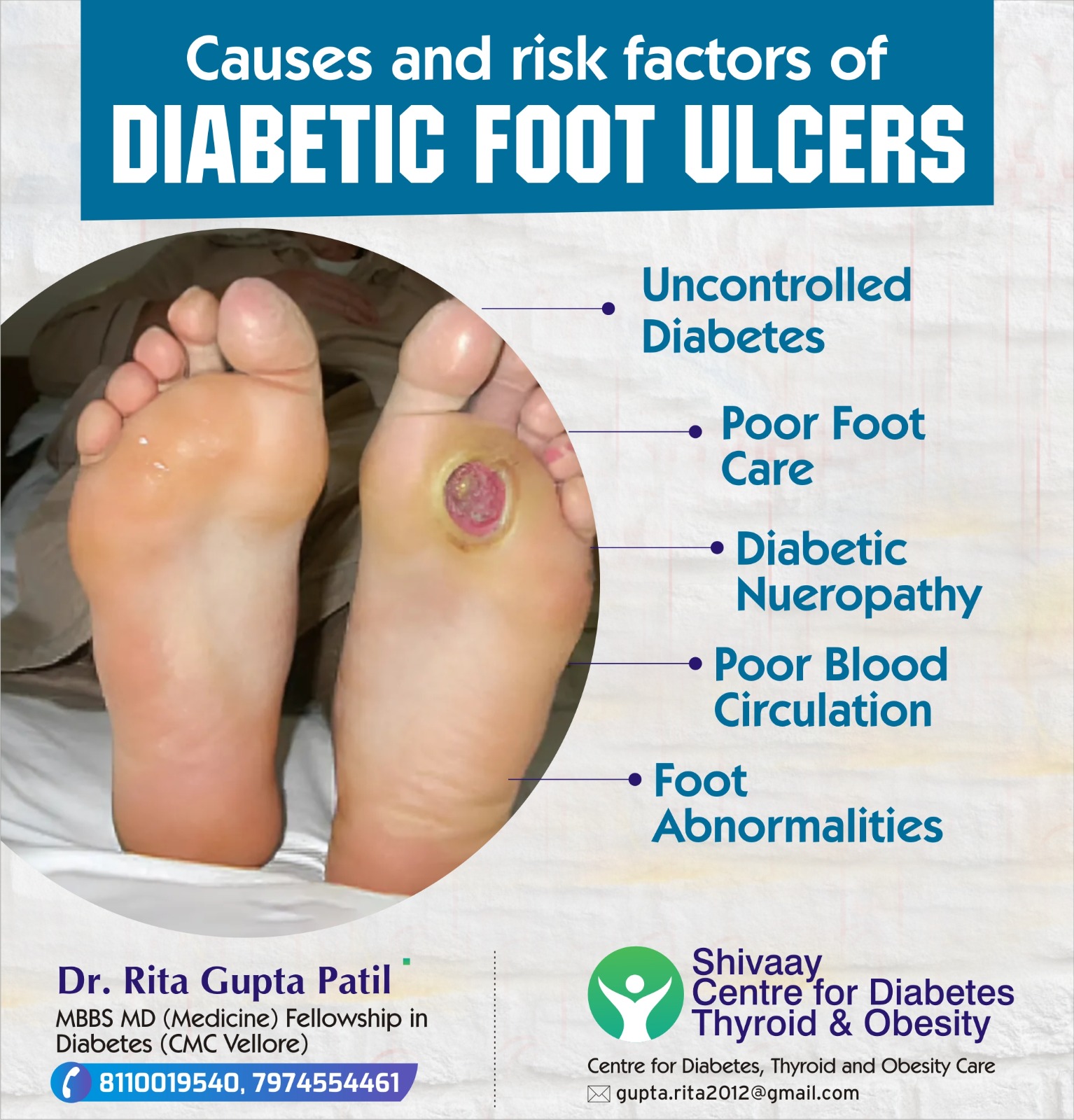 Best Doctor for Diabetic Foot Ulcer Treatment In Indore 