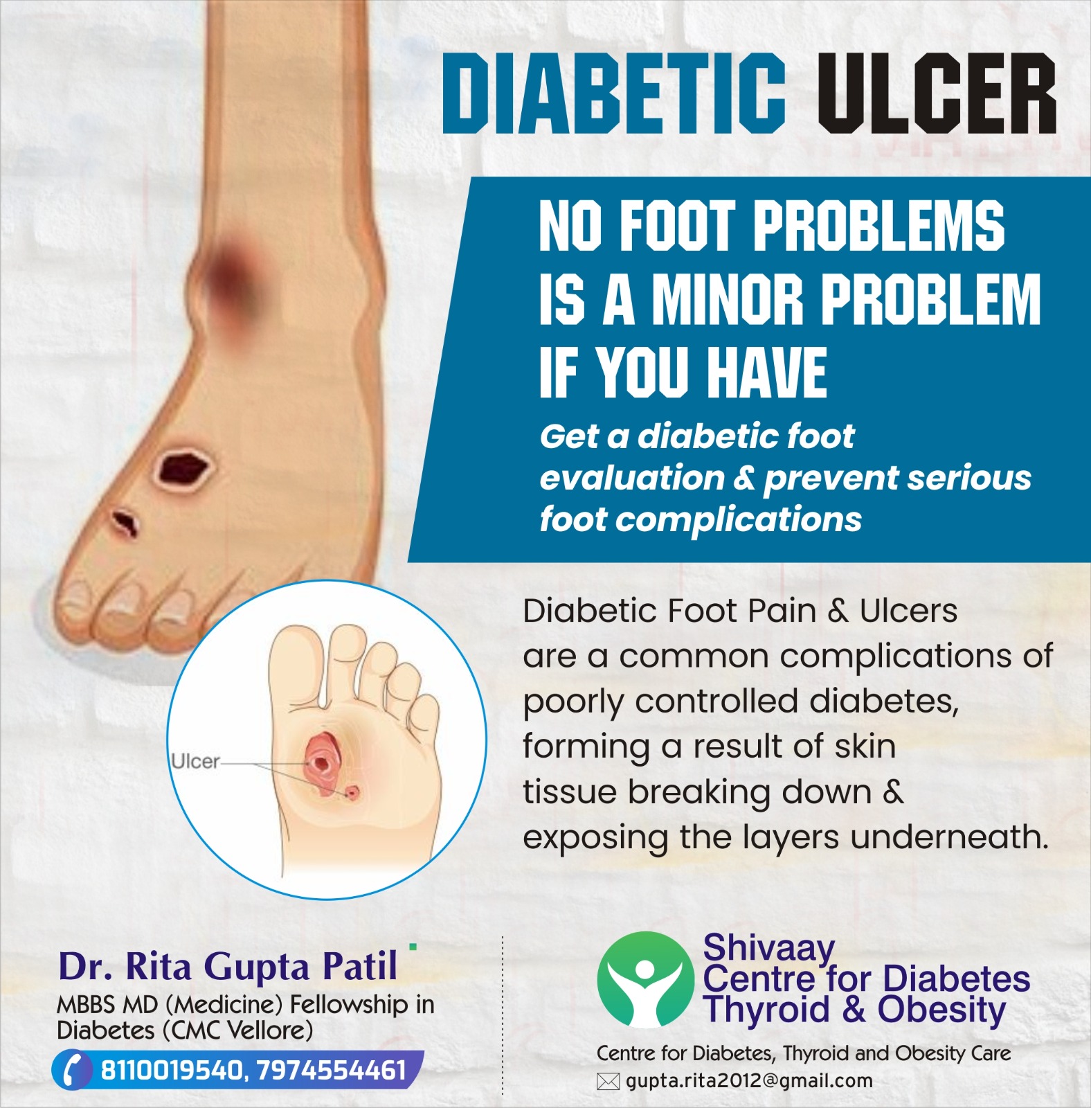 Best Doctor for Foot Ulcer Treatment in Indore